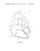 SYSTEM TO TREAT AV-CONDUCTED VENTRICULAR TACHYARRHYTHMIA diagram and image