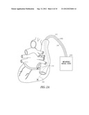 SYSTEM TO TREAT AV-CONDUCTED VENTRICULAR TACHYARRHYTHMIA diagram and image