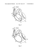 CARDIAC STIMULATING DEVICE diagram and image