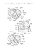 DEVICES, SYSTEMS, AND METHODS FOR RESHAPING A HEART VALVE ANNULUS,     INCLUDING THE USE OF MAGNETIC TOOLS diagram and image