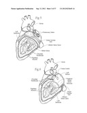 DEVICES, SYSTEMS, AND METHODS FOR RESHAPING A HEART VALVE ANNULUS,     INCLUDING THE USE OF MAGNETIC TOOLS diagram and image