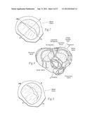 DEVICES, SYSTEMS, AND METHODS FOR RESHAPING A HEART VALVE ANNULUS,     INCLUDING THE USE OF MAGNETIC TOOLS diagram and image