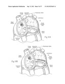 DEVICES, SYSTEMS, AND METHODS FOR RESHAPING A HEART VALVE ANNULUS,     INCLUDING THE USE OF MAGNETIC TOOLS diagram and image