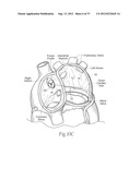 DEVICES, SYSTEMS, AND METHODS FOR RESHAPING A HEART VALVE ANNULUS,     INCLUDING THE USE OF MAGNETIC TOOLS diagram and image