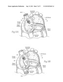 DEVICES, SYSTEMS, AND METHODS FOR RESHAPING A HEART VALVE ANNULUS,     INCLUDING THE USE OF MAGNETIC TOOLS diagram and image