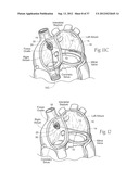 DEVICES, SYSTEMS, AND METHODS FOR RESHAPING A HEART VALVE ANNULUS,     INCLUDING THE USE OF MAGNETIC TOOLS diagram and image