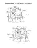 DEVICES, SYSTEMS, AND METHODS FOR RESHAPING A HEART VALVE ANNULUS,     INCLUDING THE USE OF MAGNETIC TOOLS diagram and image