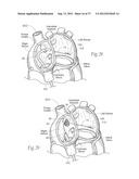 DEVICES, SYSTEMS, AND METHODS FOR RESHAPING A HEART VALVE ANNULUS,     INCLUDING THE USE OF MAGNETIC TOOLS diagram and image