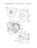 DEVICES, SYSTEMS, AND METHODS FOR RESHAPING A HEART VALVE ANNULUS,     INCLUDING THE USE OF MAGNETIC TOOLS diagram and image