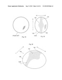 HUMERAL JOINT REPLACEMENT COMPONENT diagram and image