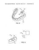 INTRA-ORAL CHARGING SYSTEMS AND METHODS diagram and image
