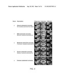 TREATMENT OF SUBMENTAL FAT diagram and image