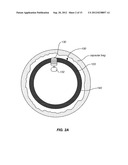 EXPANDABLE IMPLANTABLE PRESSURE SENSOR FOR INTRAOCULAR SURGERY diagram and image