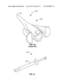 EXPANDABLE IMPLANTABLE PRESSURE SENSOR FOR INTRAOCULAR SURGERY diagram and image