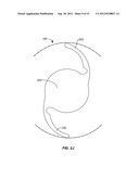 EXPANDABLE IMPLANTABLE PRESSURE SENSOR FOR INTRAOCULAR SURGERY diagram and image