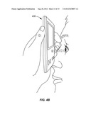 EXPANDABLE IMPLANTABLE PRESSURE SENSOR FOR INTRAOCULAR SURGERY diagram and image