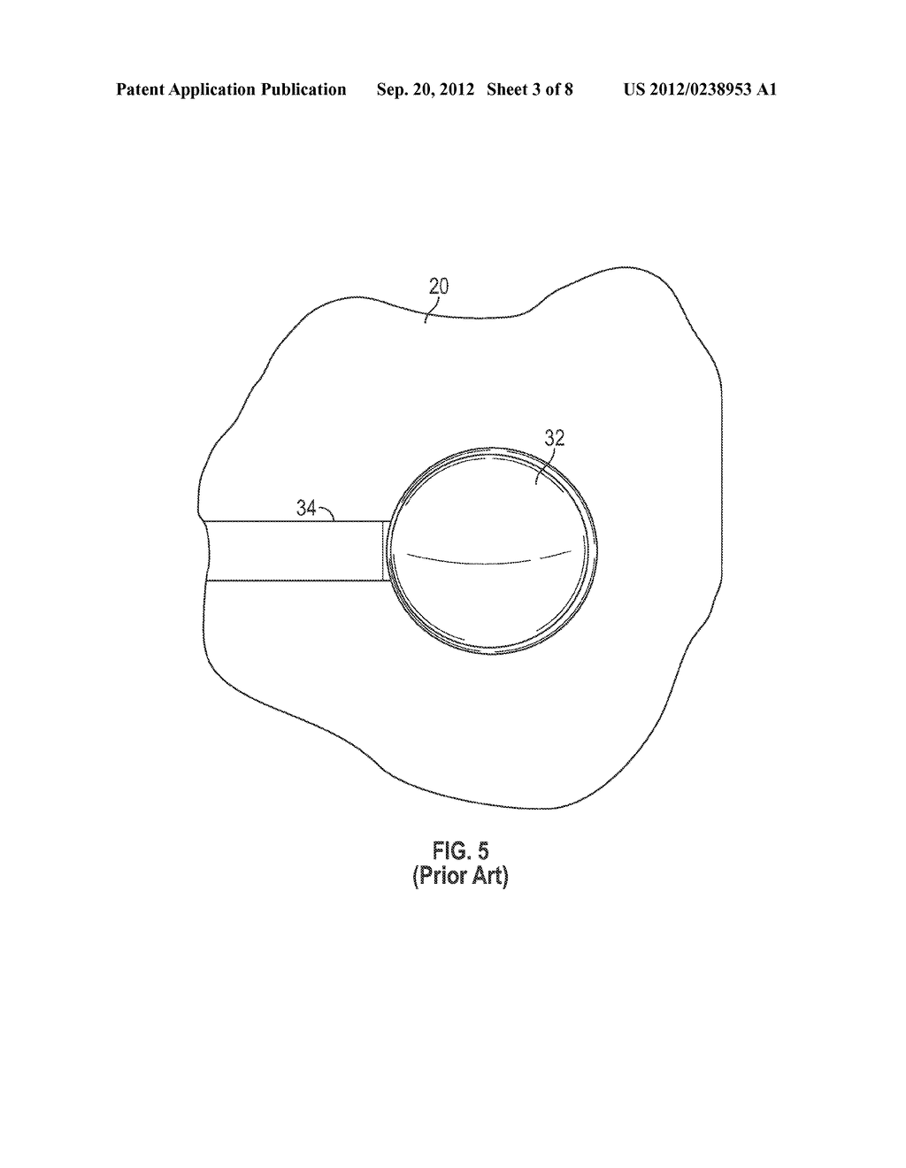 BIOPSY SPACER DEVICE AND METHOD OF OPERATION - diagram, schematic, and image 04