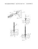 Combination Driver/Anti-Rotation Handle for Shoulder Arthroplasty diagram and image