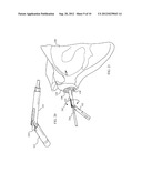 Combination Driver/Anti-Rotation Handle for Shoulder Arthroplasty diagram and image