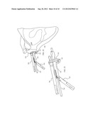 Combination Driver/Anti-Rotation Handle for Shoulder Arthroplasty diagram and image