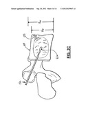 APPARATUS AND METHOD FOR STYLET-GUIDED VERTEBRAL AUGMENTATION diagram and image