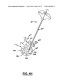 APPARATUS AND METHOD FOR STYLET-GUIDED VERTEBRAL AUGMENTATION diagram and image