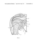 Device and Method for Retroversion Correction for Shoulder Arthroplasty diagram and image