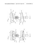 Device and Method for Retroversion Correction for Shoulder Arthroplasty diagram and image