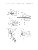 Device and Method for Retroversion Correction for Shoulder Arthroplasty diagram and image