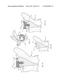 Device and Method for Retroversion Correction for Shoulder Arthroplasty diagram and image