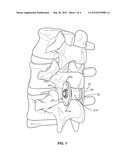 INTERSPINOUS PROCESS IMPLANT AND METHOD OF IMPLANTATION diagram and image