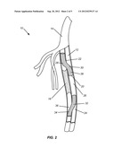 DEFFERENTIAL DILATION STENT AND METHOD OF USE diagram and image