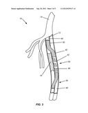 DEFFERENTIAL DILATION STENT AND METHOD OF USE diagram and image