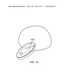 Insole Electromagnetic Therapy Device diagram and image