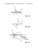 Adapter for Attaching Electromagnetic Image Guidance Components to a     Medical Device diagram and image