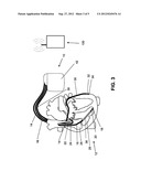 IMPLANTABLE MEDICAL DEVICE diagram and image