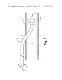 SLEEVE VALVE CATHETERS diagram and image