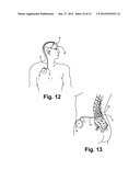 SLEEVE VALVE CATHETERS diagram and image