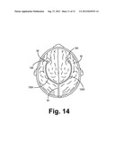 SLEEVE VALVE CATHETERS diagram and image