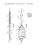 METHOD AND SYSTEM FOR TREATING VALVE STENOSIS diagram and image