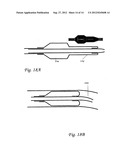 BALLOON CATHETER SYSTEM FOR TREATING VASCULAR OCCLUSIONS diagram and image