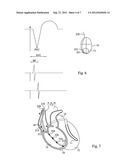 CARDIAC STIMULATING DEVICE diagram and image