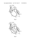 CARDIAC STIMULATING DEVICE diagram and image