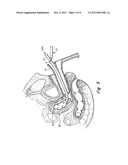 CERVICAL OCCLUDER diagram and image