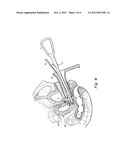 CERVICAL OCCLUDER diagram and image