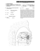 ORAL APPLIANCE FOR THE TREATMENT OF SLEEP APNEA diagram and image