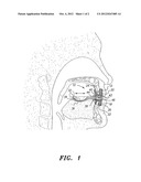 ORAL APPLIANCE FOR THE TREATMENT OF SLEEP APNEA diagram and image