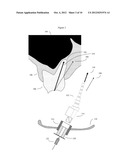 METHOD AND KIT FOR DENTAL IMPLANT DRILLING GUIDES diagram and image