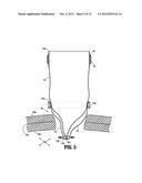 SURGICAL ACCESS ASSEMBLY WITH SLEEVE AND ADJUSTABLE FASTENER diagram and image