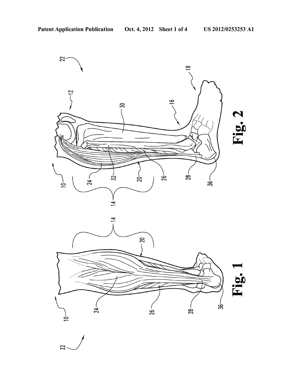 Adjustable-Sole, Hinged Equinus Brace With Toe Wedge - diagram, schematic, and image 02